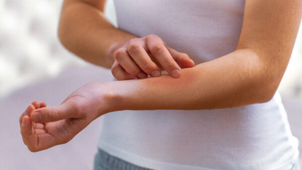 Алергиите и обривите са често срещан симптом на спад в имунитета.
